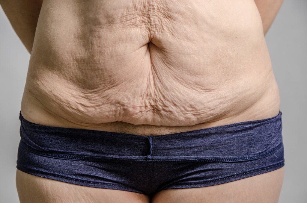 Dealing with Excess Skin After Weight Loss: Understanding and Managing the Transformation